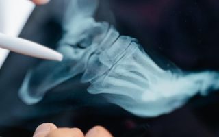 Revolucija u medicini: Kinezi izumeli lepak za kosti; Rešava prelome za samo tri minuta