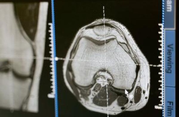 Pet simptoma moždanog udara - znak da treba odmah pozvati Hitnu pomoć