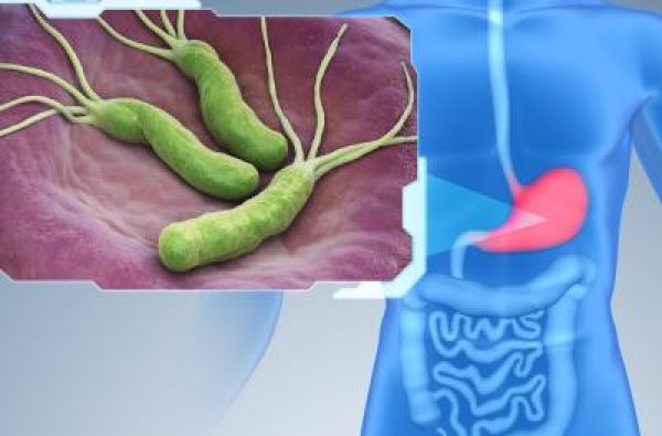 Heliko bakterija: Kako se prenosi i koji su simptomi