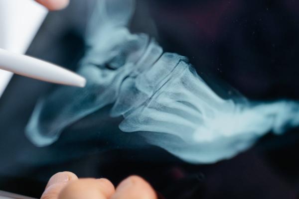 Revolucija u medicini: Kinezi izumeli lepak za kosti; Rešava prelome za samo tri minuta