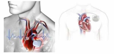 Započeta primena nove zdravstvene tehnologije „Implantacija pejsmejkera i kardioverter defibrilitarora“