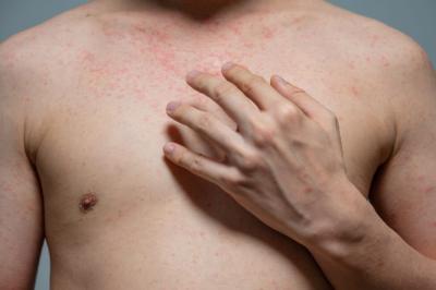 Epidemija malih boginja ne posustaje: Za samo 7 dana 30 novih slučajeva u četiri grada