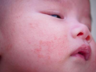 Sve više beba u Srbiji ima ekcem i alergije, a ovo je glavni razlog tome